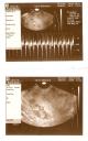 BK @ 10 wks 4 days